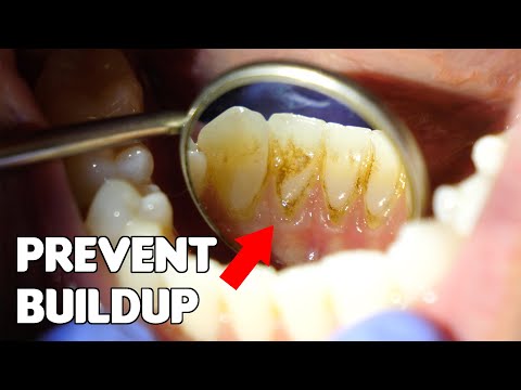 How to Prevent Buildup on Bottom Front Teeth